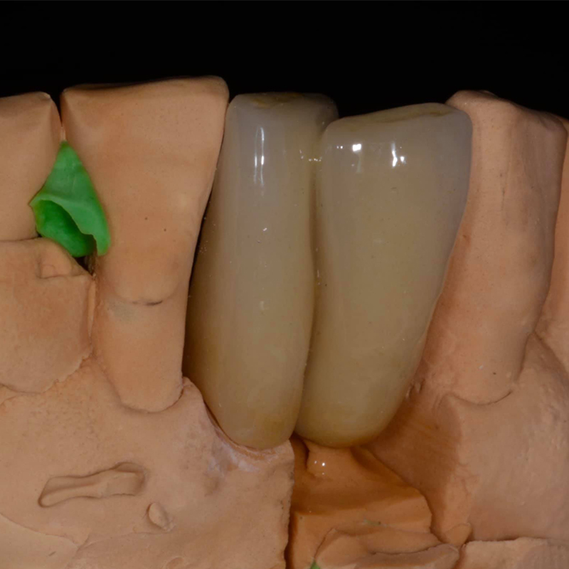 À qui conviennent les dents en porcelaine ?