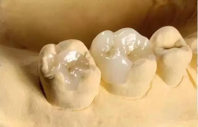 Incrustation dentaire en zircone pour récupérer les petits défauts de surface des dents naturelles