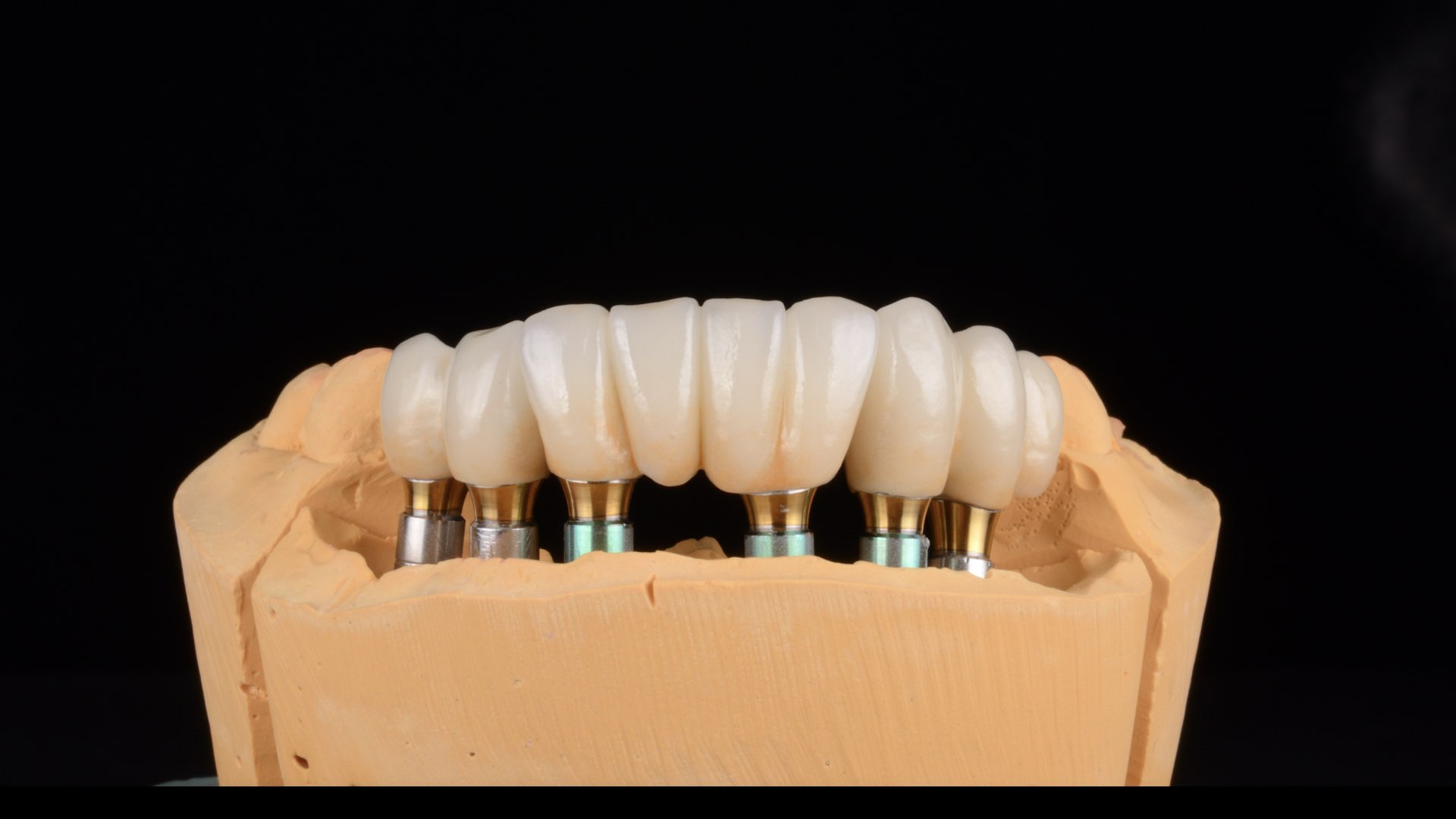 Comment prendre soin des implants dentaires ?