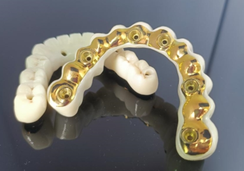 Barre implantaire CAD/CAM en titane + pont en zircone
