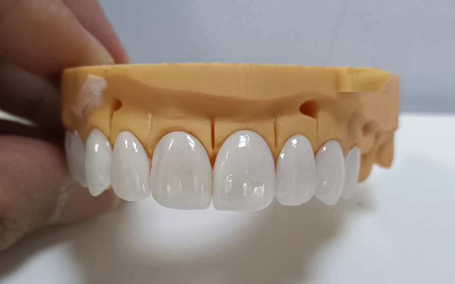 Facettes Emax hautement esthétiques