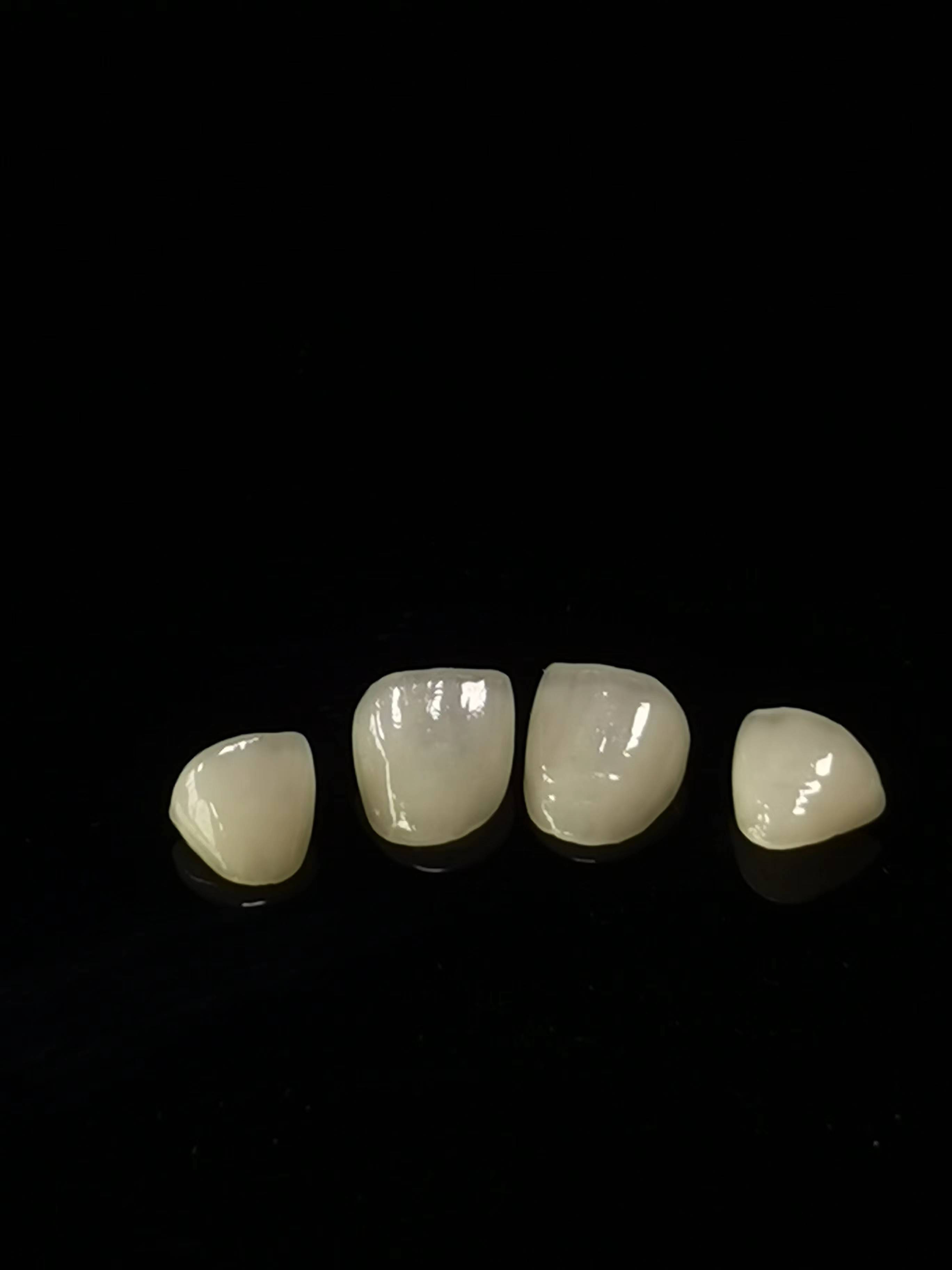 E.max Dental lab Work