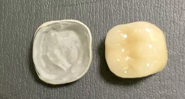 Quelles conditions sont nécessaires pour obtenir des couronnes fusionnées en porcelaine?