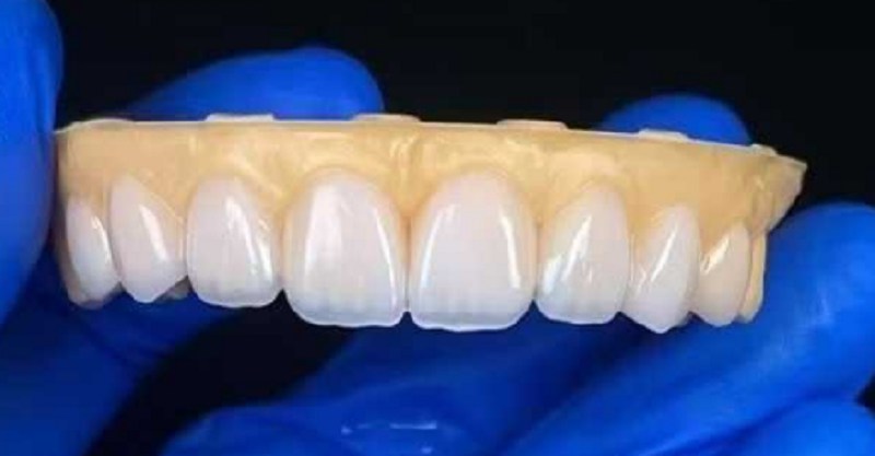 Placages dentaires pour réparer le problème des lacunes de dents excessives
