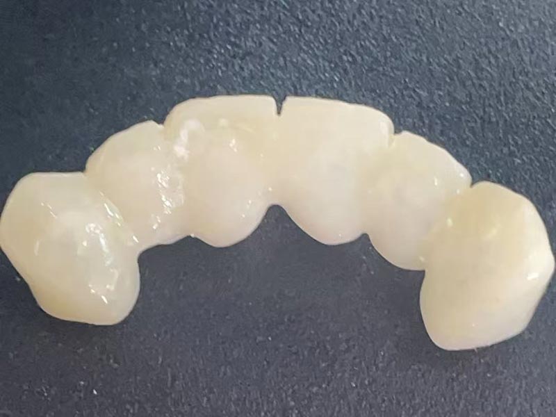 Qu'est-ce qu'une « couronne temporaire » ? Pourquoi en avez-vous besoin ?