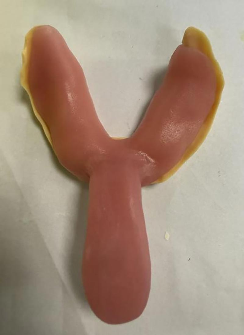 Choses que vous ne saviez pas sur les gouttières dentaires personnalisées