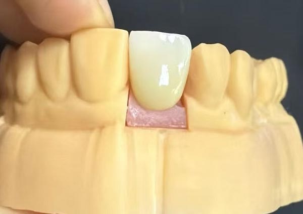 Les espaces entre les dents peuvent être comblés : les dents droites sont les plus attrayantes !