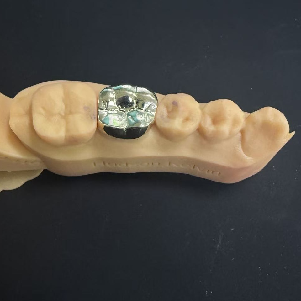 Couronnes en or : le choix en métal précieux pour une restauration dentaire à vie