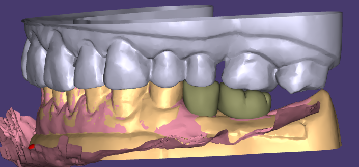 Les cires esthétiques et les restaurations provisoires de WM Dental Lab sont unanimement acclamées par les clients