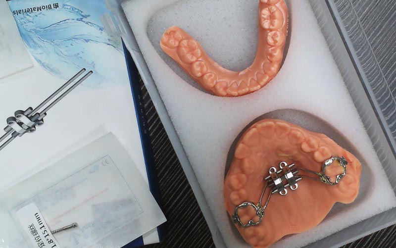 Comprendre l'expansion squelettique MSE avec WM Dental Lab