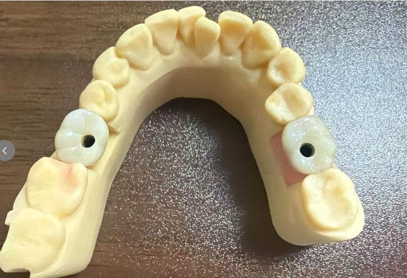 Pourquoi l’implantation d’une dent antérieure est-elle plus difficile que l’implantation d’une dent postérieure ?