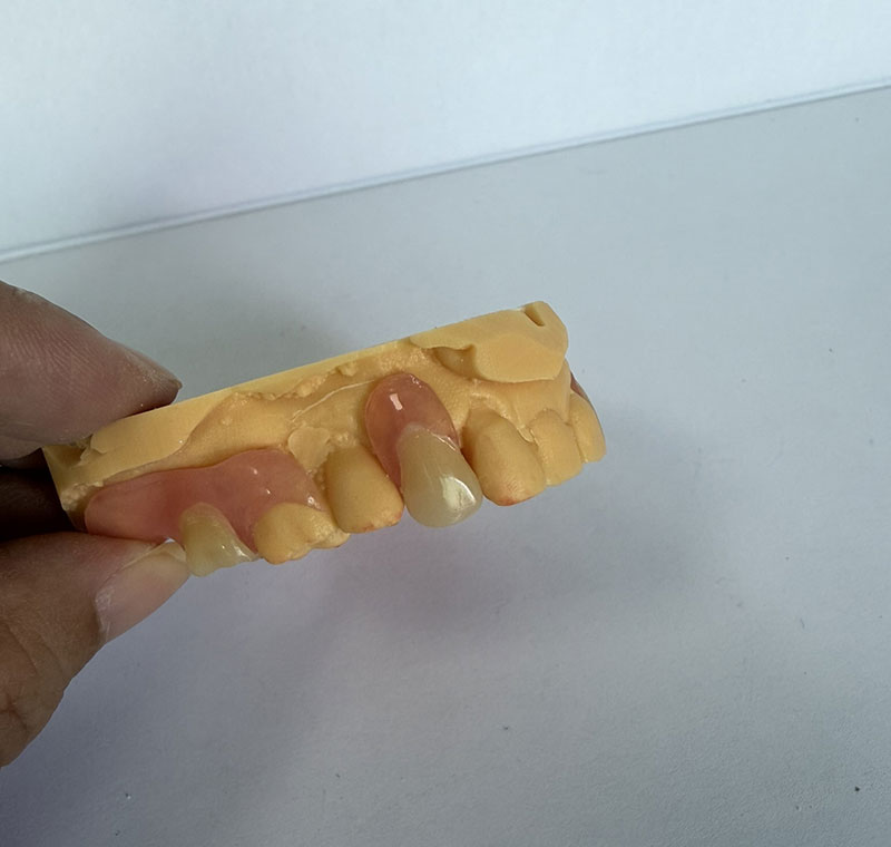 Partiels Valplast au laboratoire dentaire WM