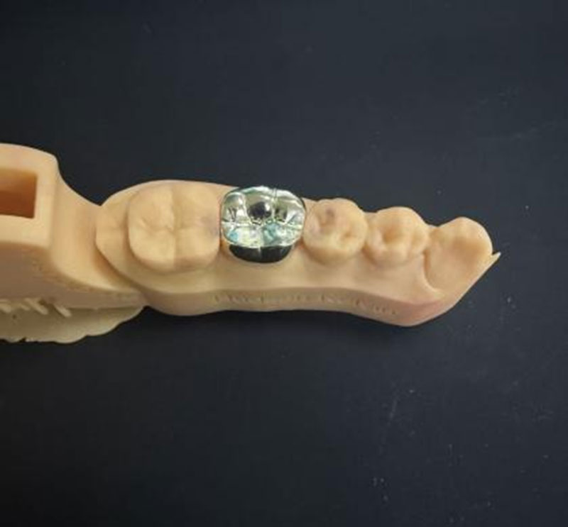 Dents en or contre dents NPG