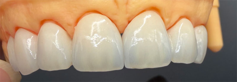Impact des dents non vitales sur les couronnes tout céramique et les traitements correspondants