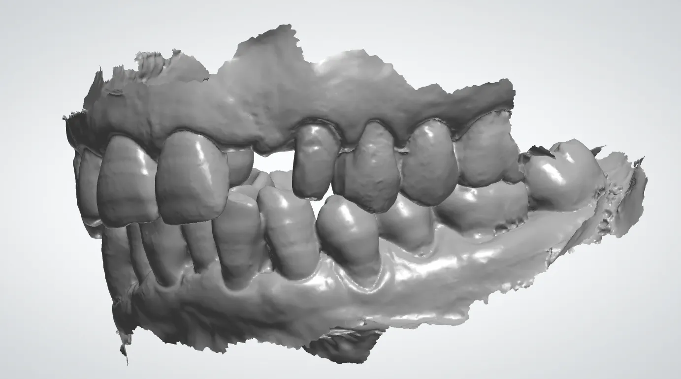 Restaurez votre sourire : les meilleures solutions pour les dents manquantes