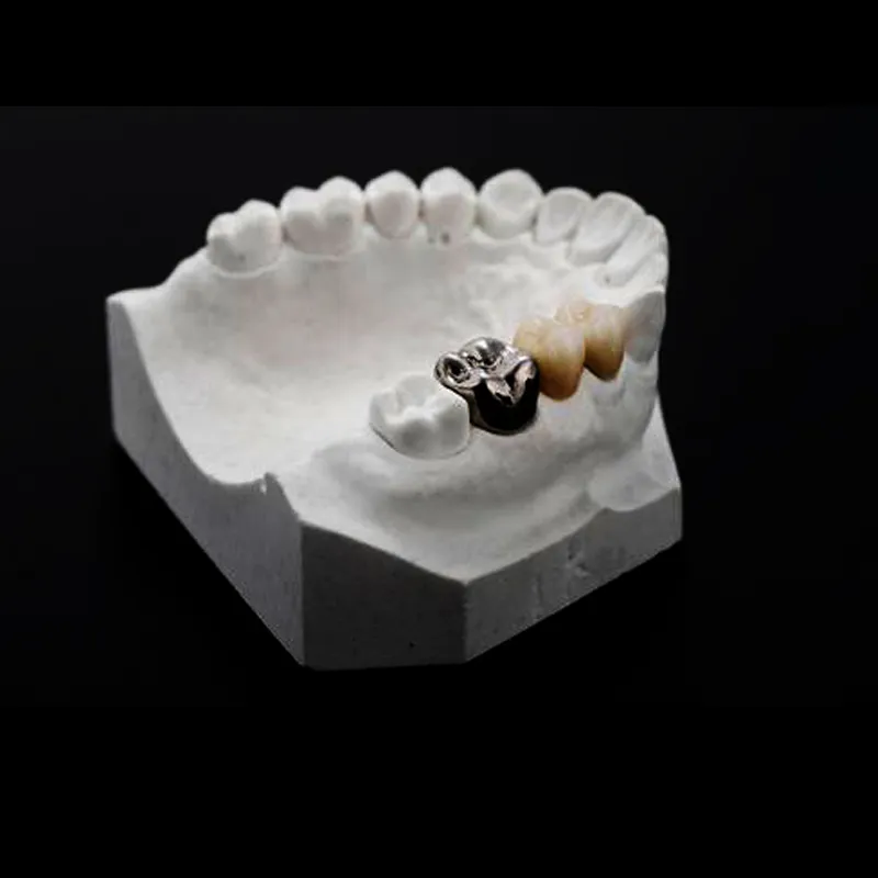 Quand les cliniciens devraient-ils choisir une couronne entièrement métallique pour les restaurations postérieures ?