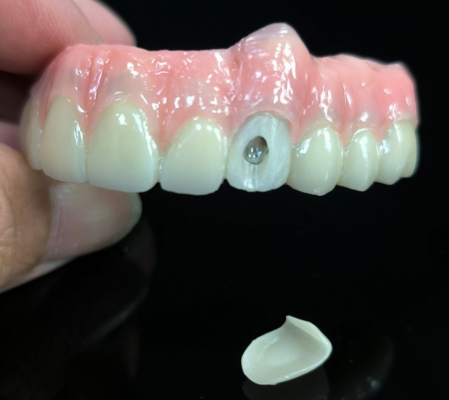 Tous sur 4 hybrides - solution de pont hybride en zircone pour le trou de vis vestibulaire