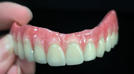 Tous sur 4 Hybrid - Malo Bridge Full Zirconia Crowns sur la structure en titane